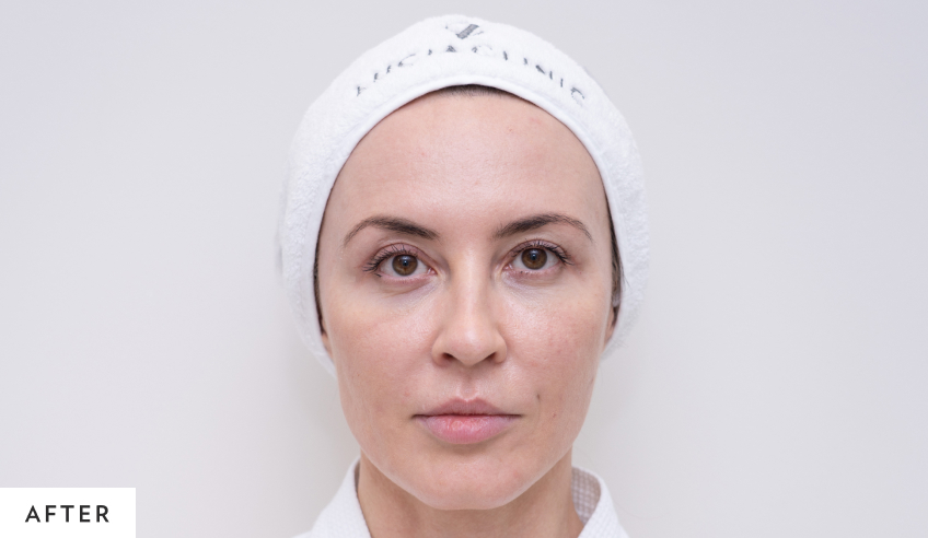 after_blepharoplasty_homepage