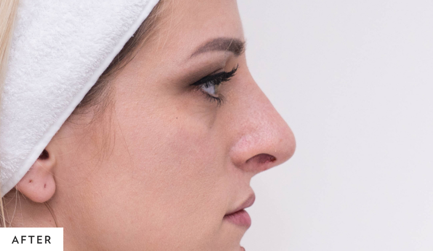 after_rhinoplasty_hp