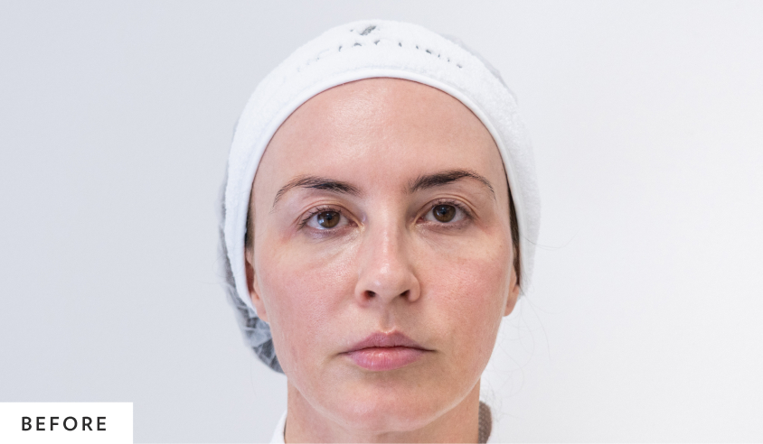 before_blepharoplasty_homepage
