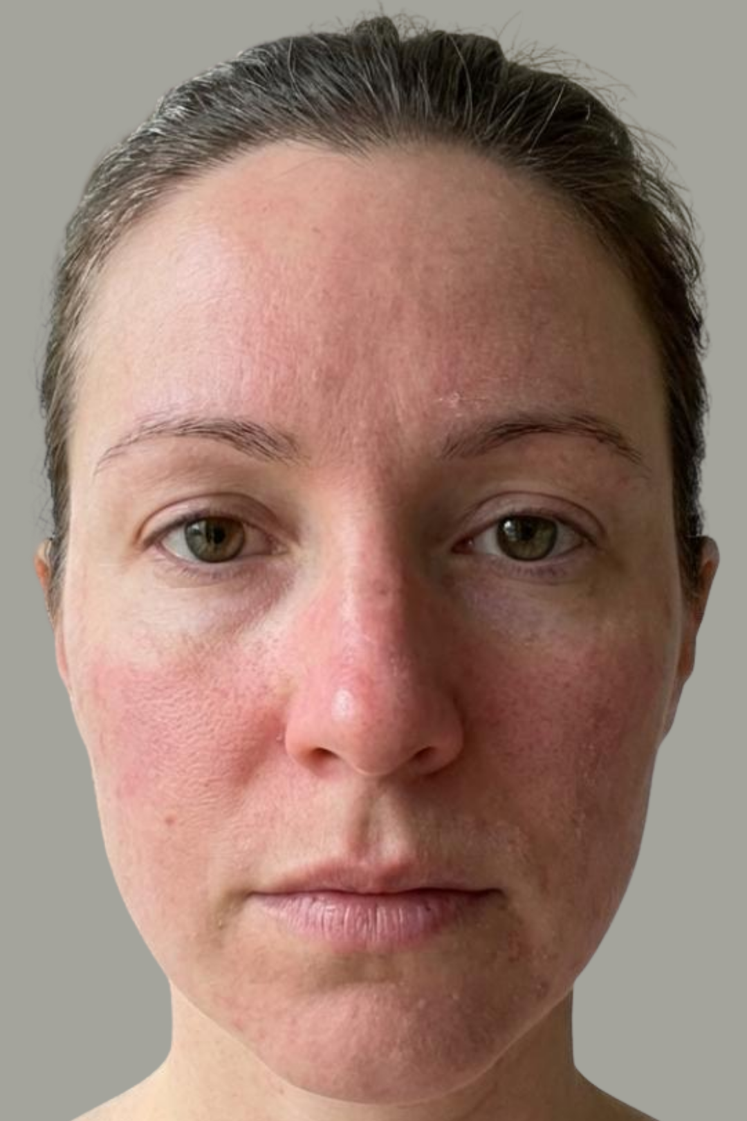 The Vitch Dermal Reset 4 105