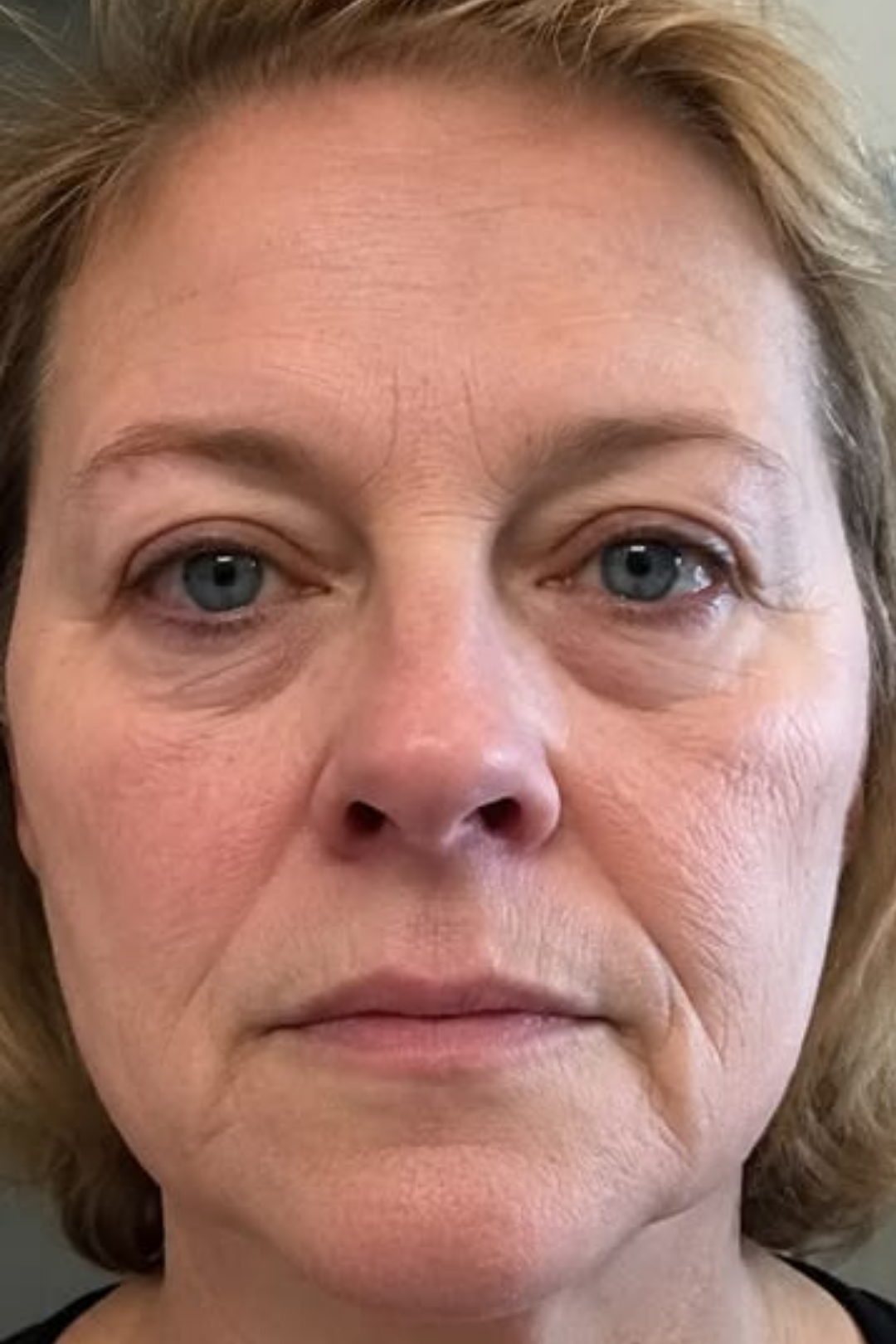 Biostimulatory Dermal Restructuring 6 49