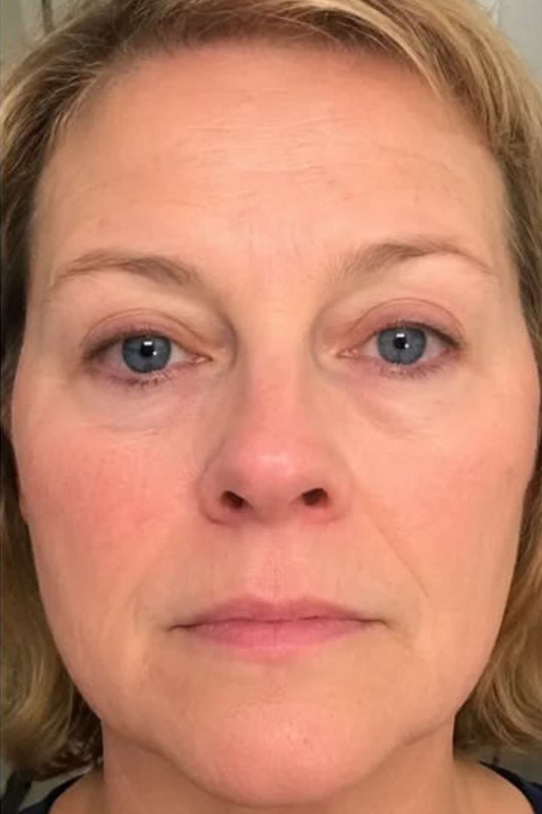 Biostimulatory Dermal Restructuring 7 50