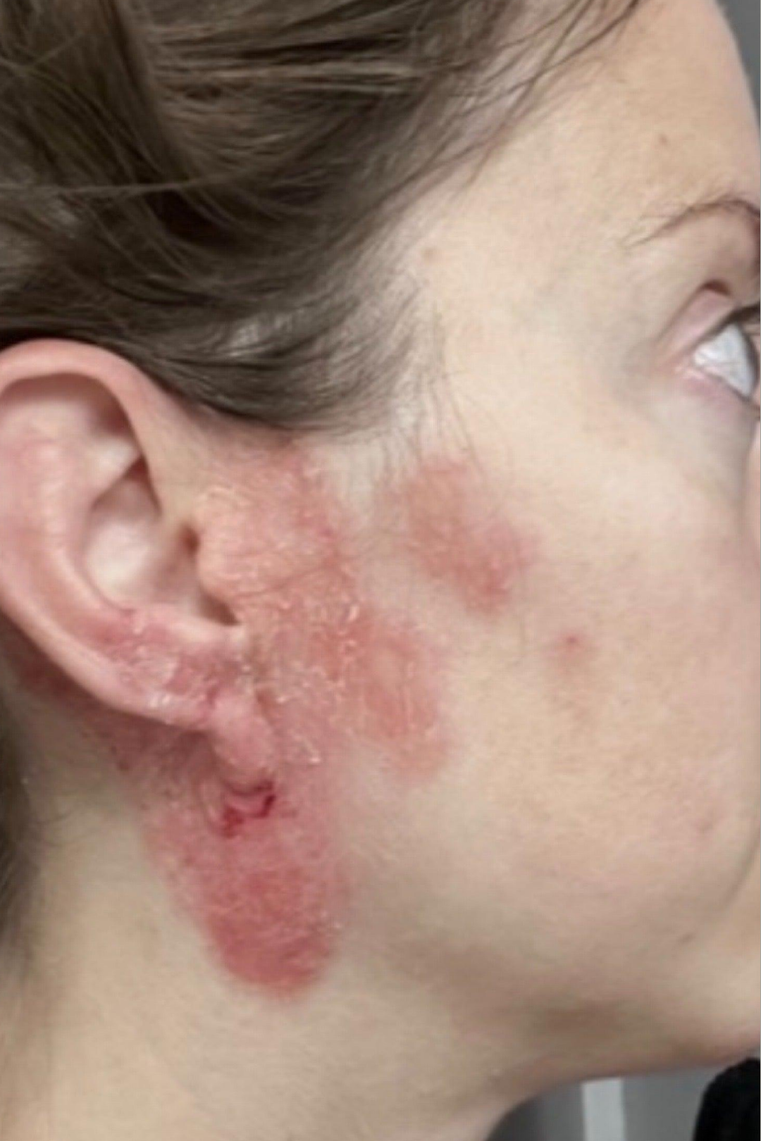Eczema & Dermatitis Barrier Defense 4 65