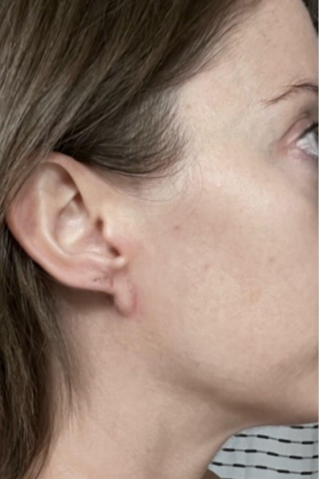 Eczema & Dermatitis Barrier Defense 5 66