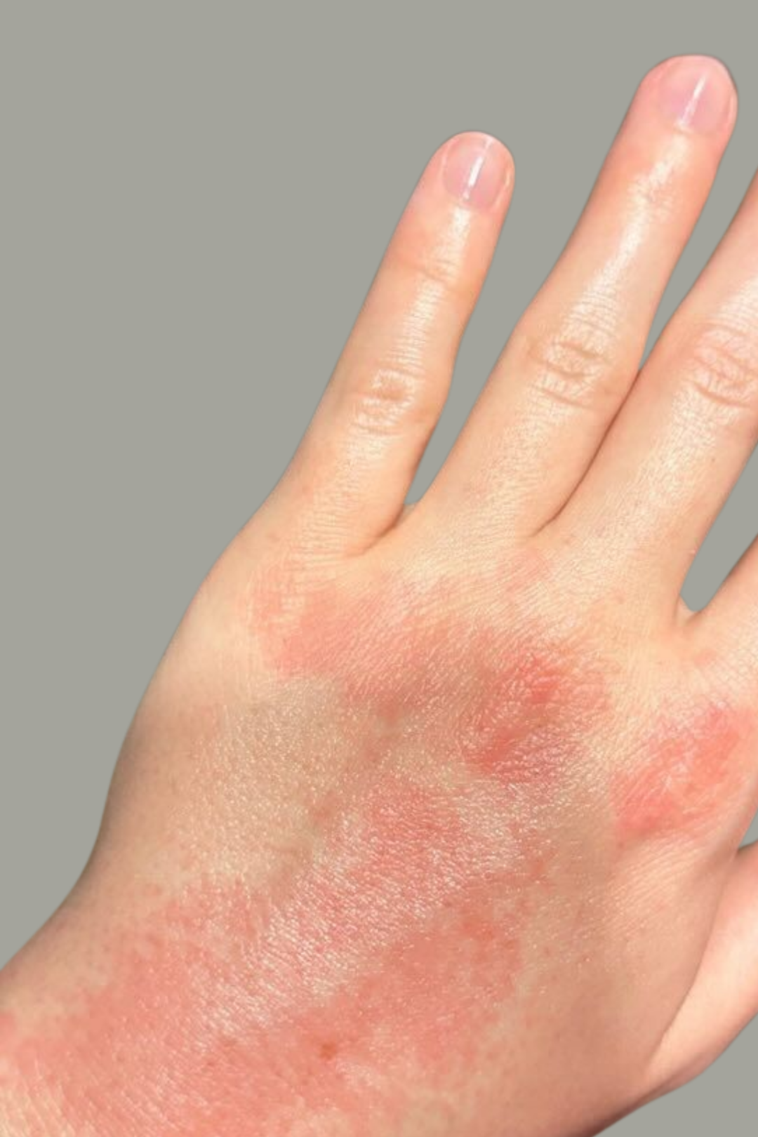 Eczema & Dermatitis Barrier Defense 6 67
