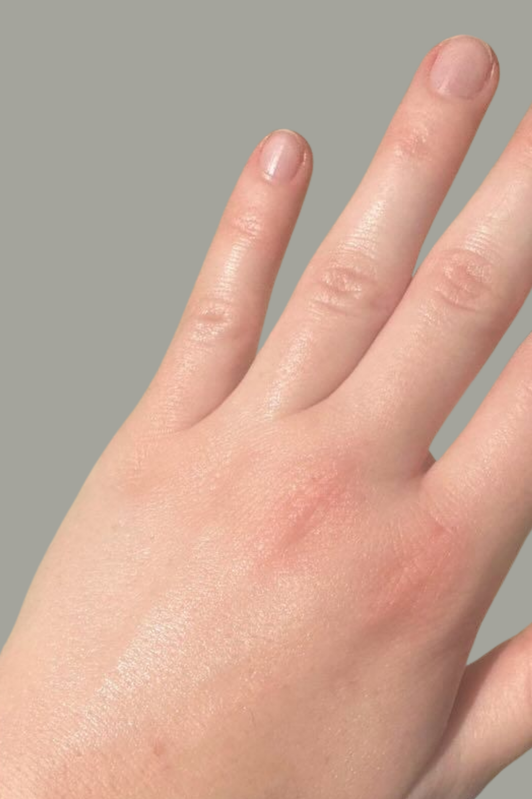 Eczema & Dermatitis Barrier Defense 7 68