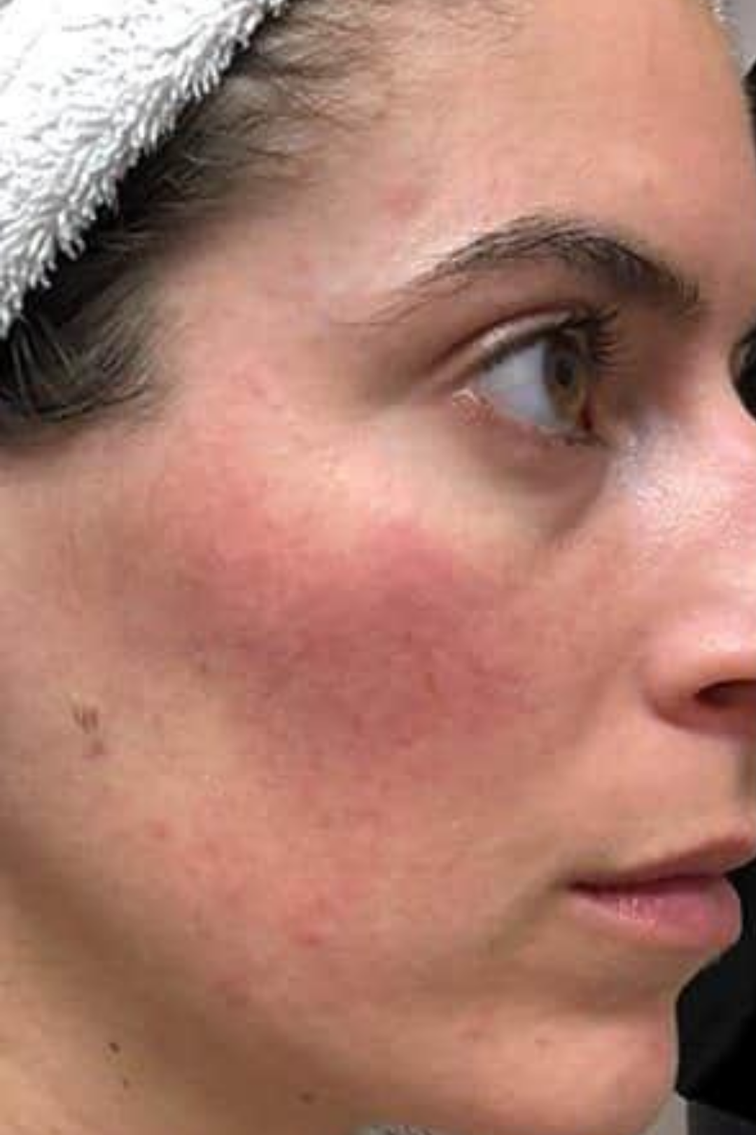 Rosacea & Vascular Calibration 4 71