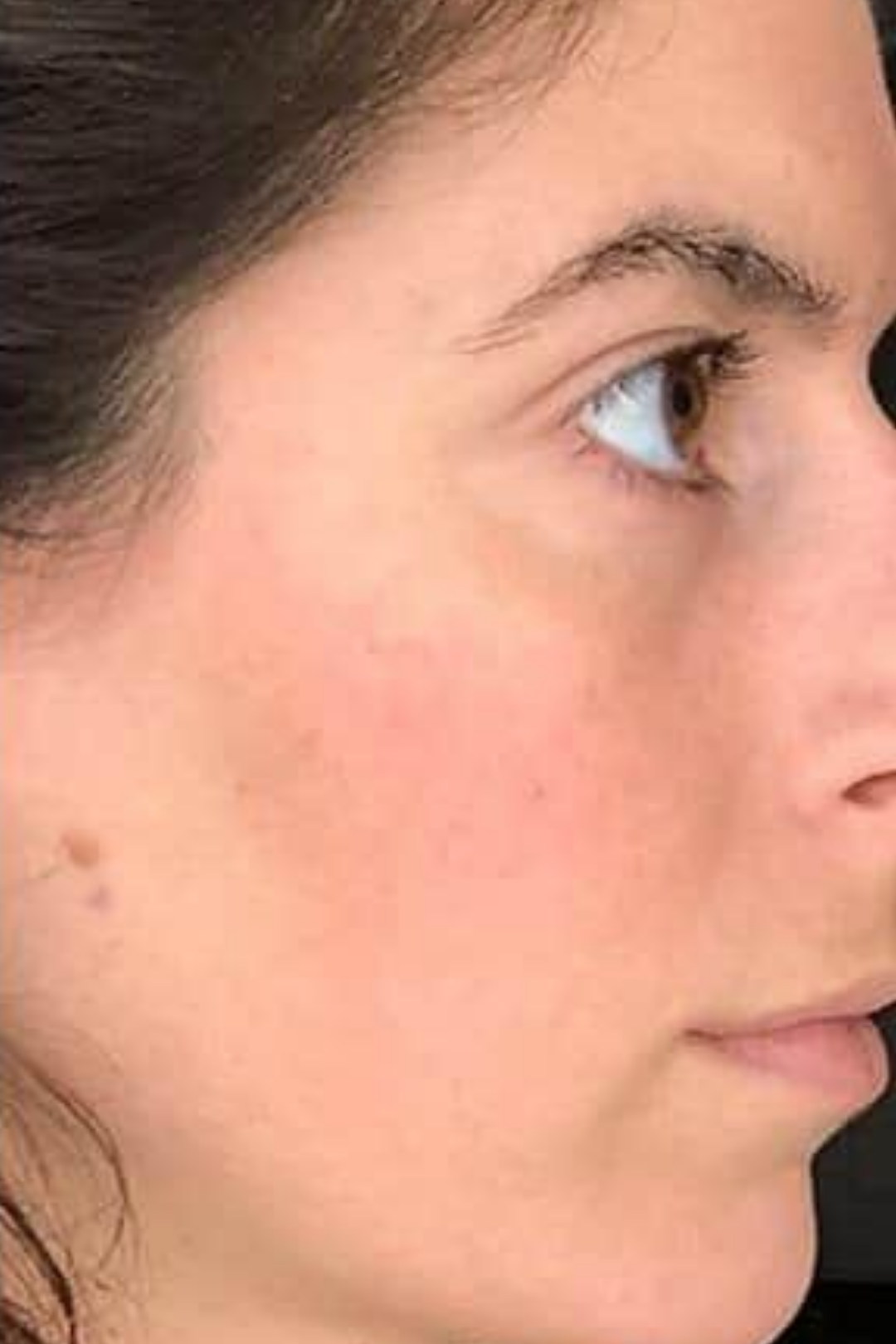 Rosacea & Vascular Calibration 5 72