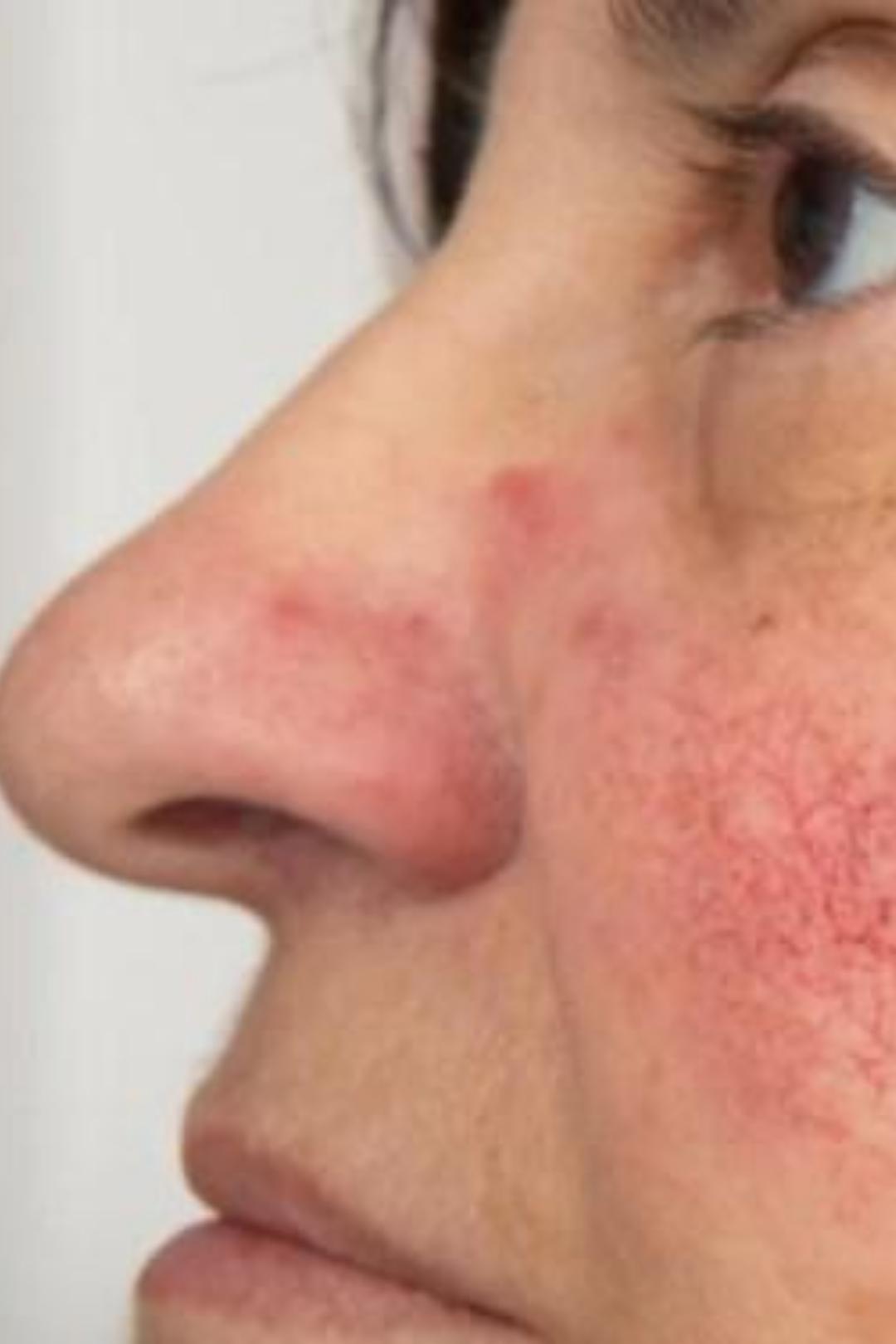 Rosacea & Vascular Calibration 6 73