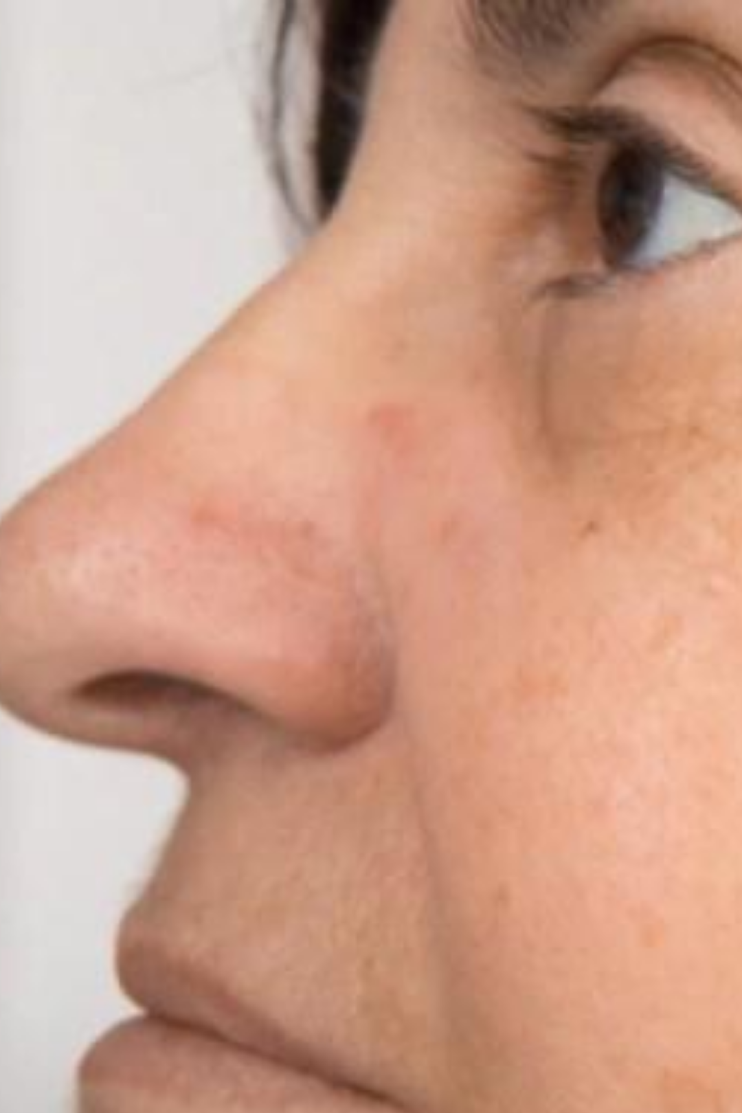 Rosacea & Vascular Calibration 7 74