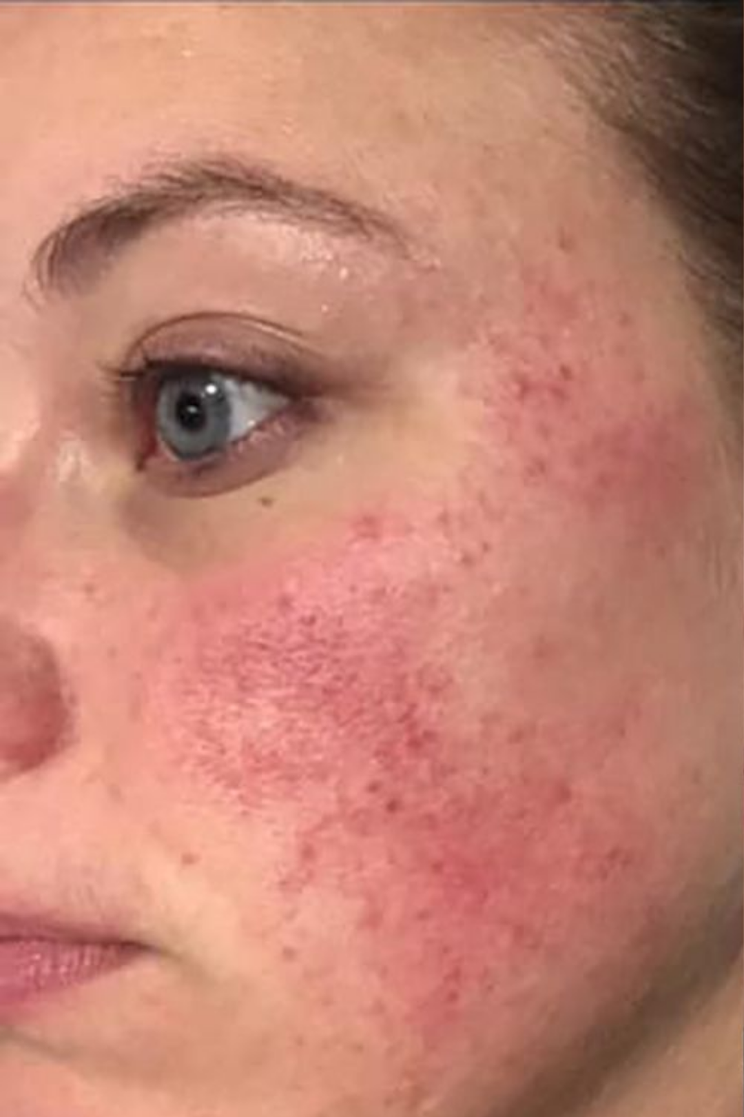 Rosacea & Vascular Calibration 8 75