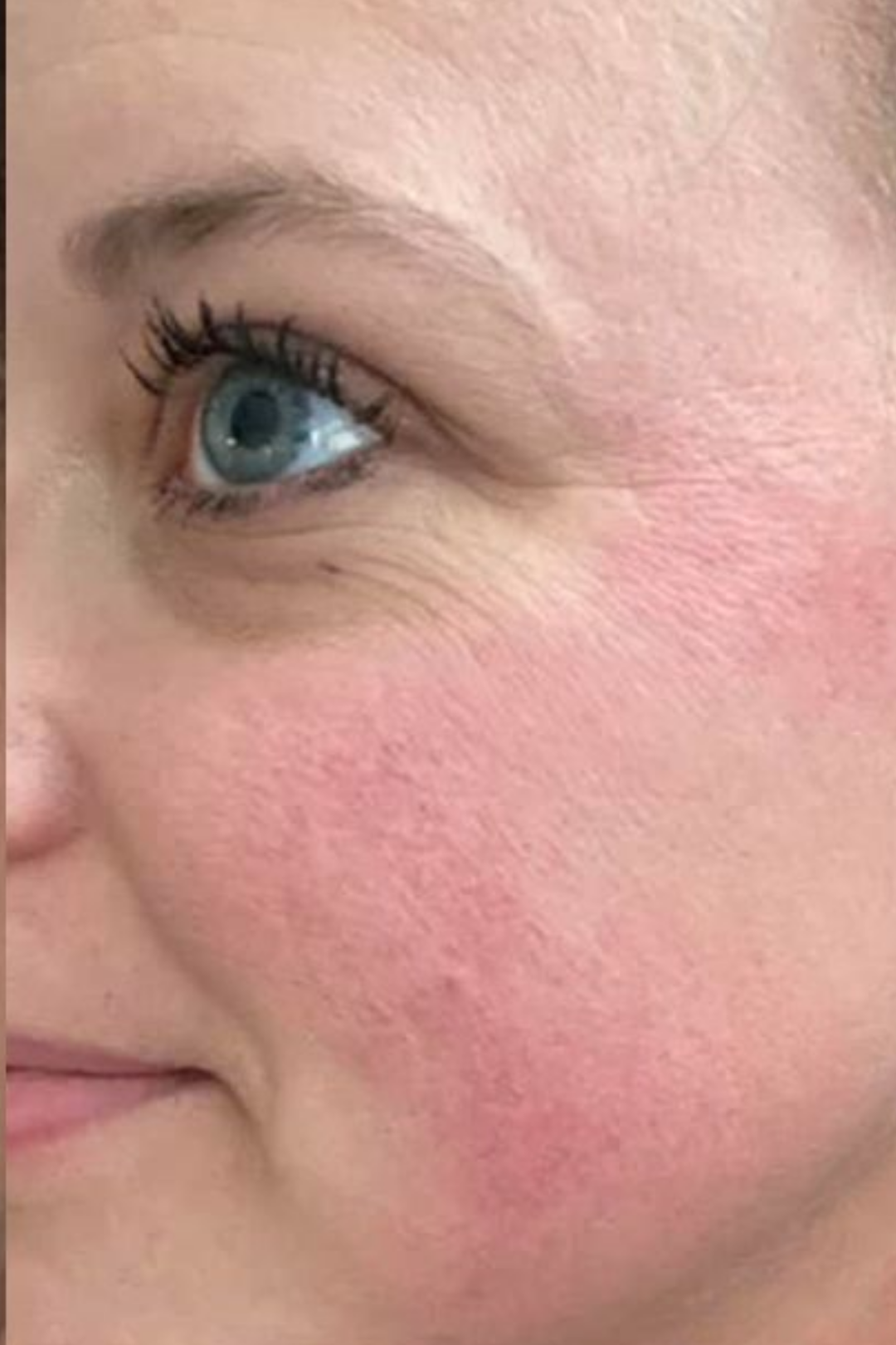 Rosacea & Vascular Calibration 9 76