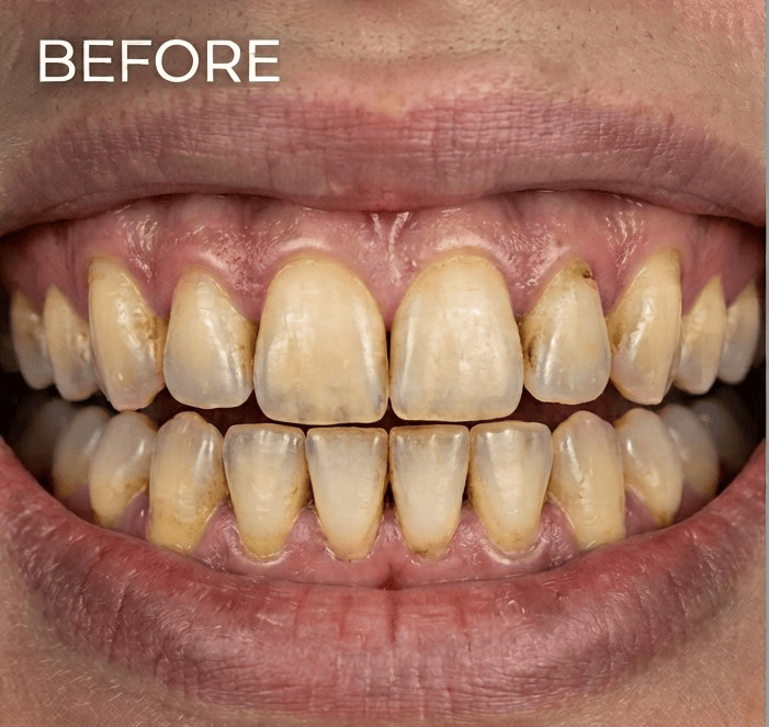 Veneers 5 hfjhfuy