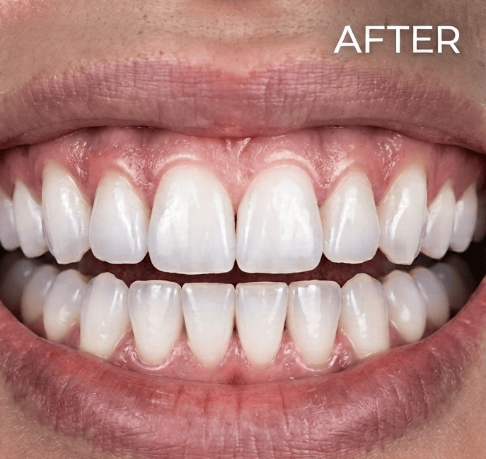 Veneers 4 ytdkutytyk e1789988769890